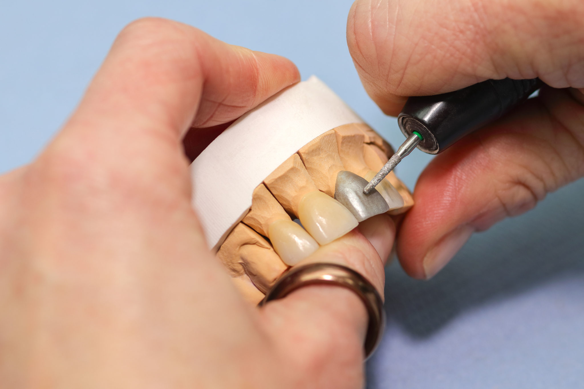 Keramik, Verblendungen, Alternativen Best Dental