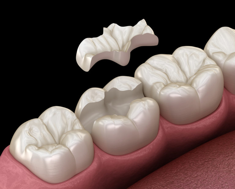 Inlay, Onlay, Overlay, Veneer Best Dental